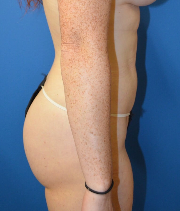 Fat transfer to buttocks/hips After