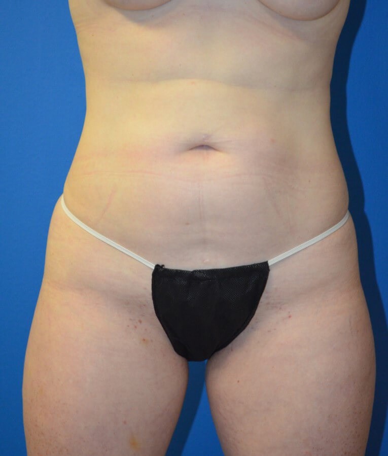 Fat transfer to buttocks/hips Before