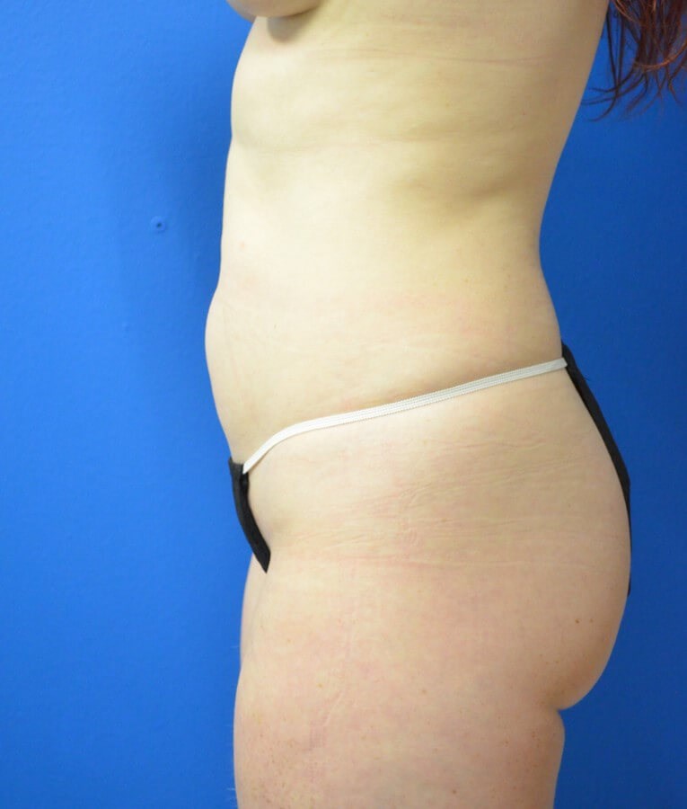 Fat transfer to buttocks/hips Before