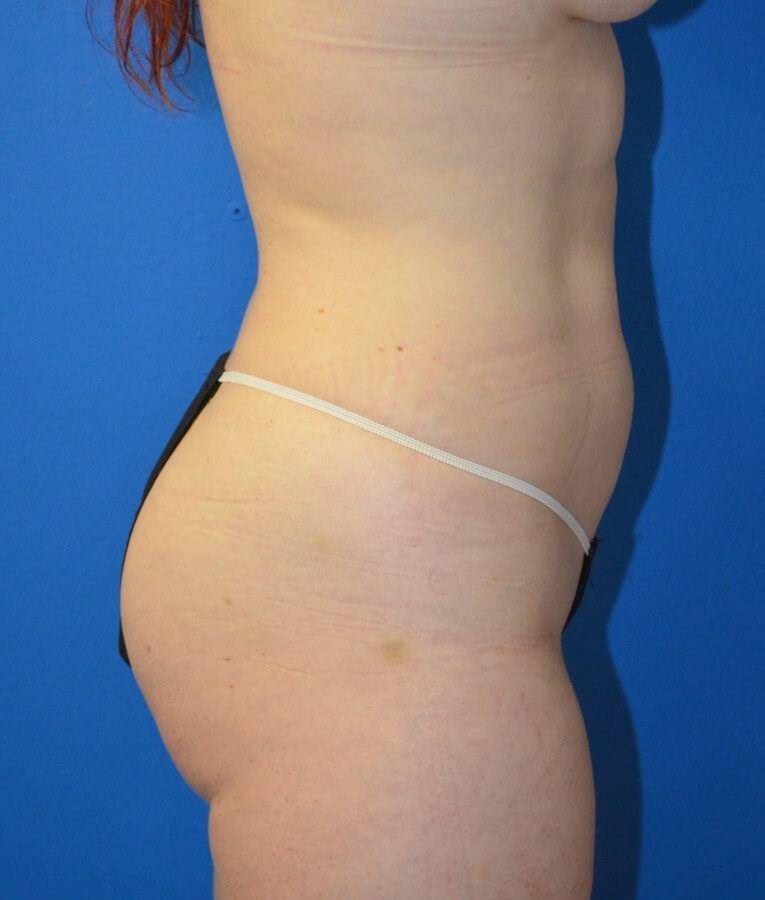 Fat transfer to buttocks/hips Before
