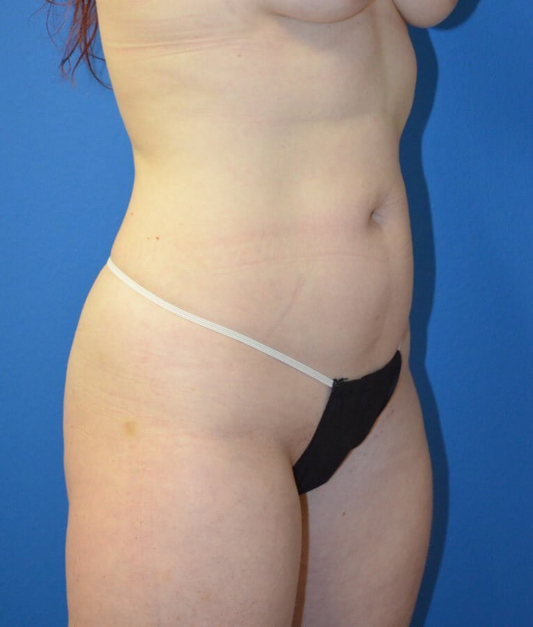Fat transfer to buttocks/hips Before