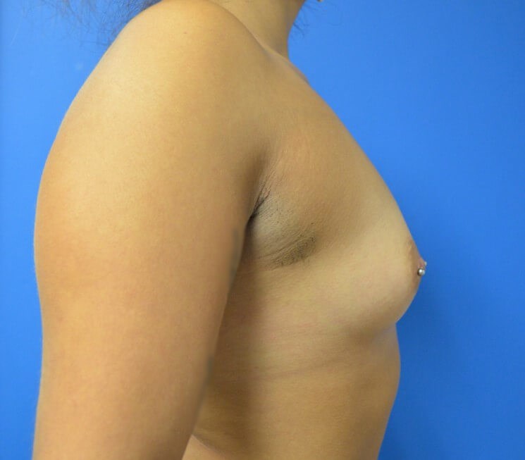 Breast augmentation 350 cc IMF Before