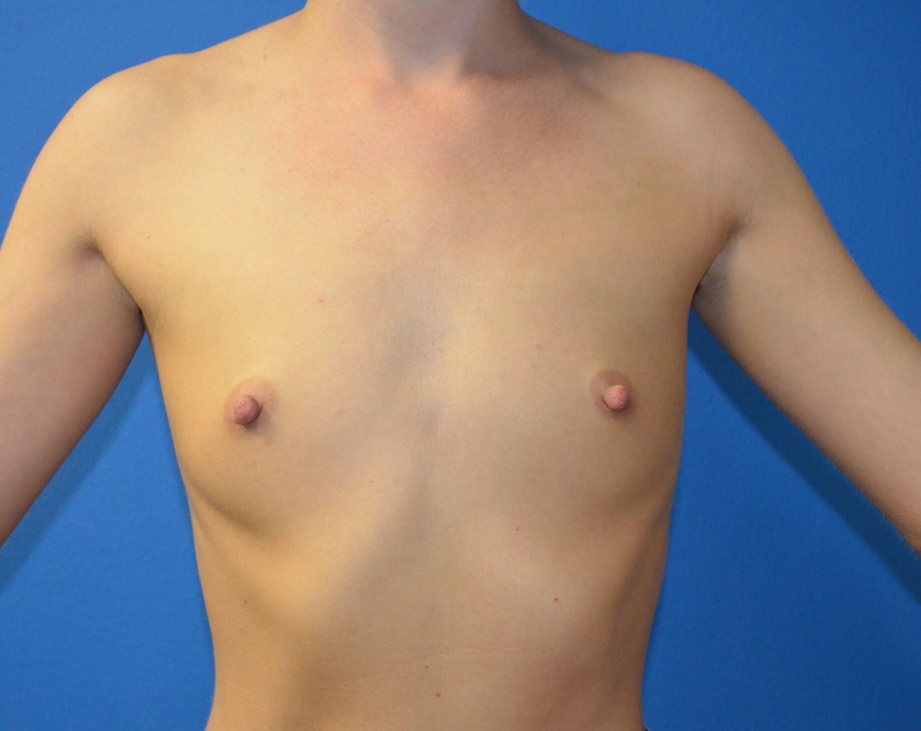 Breast augmentation 285 cc IMF Before