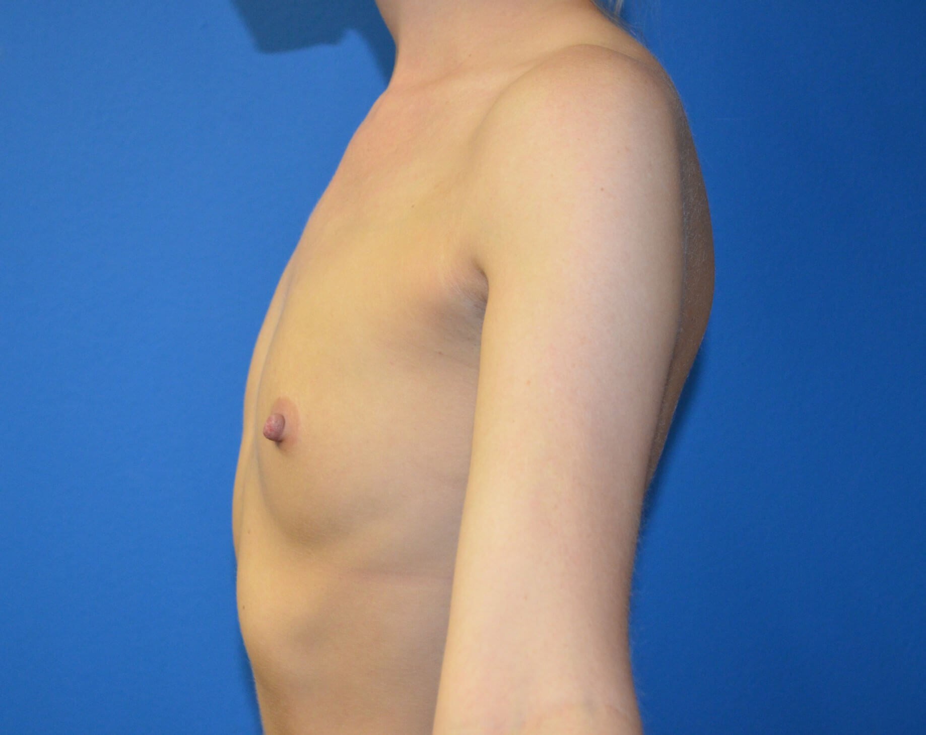 Breast augmentation 285 cc IMF Before