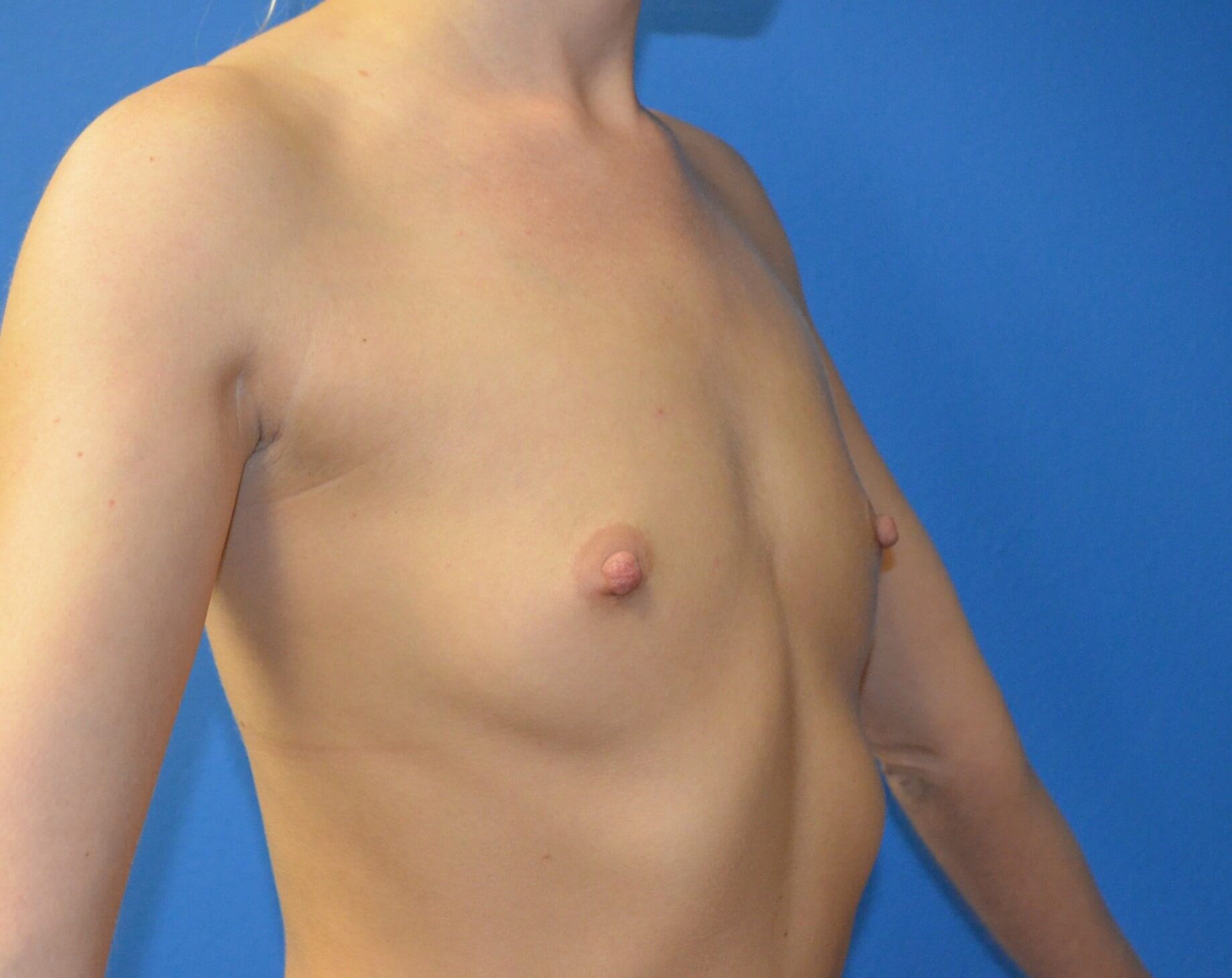 Breast augmentation 285 cc IMF Before