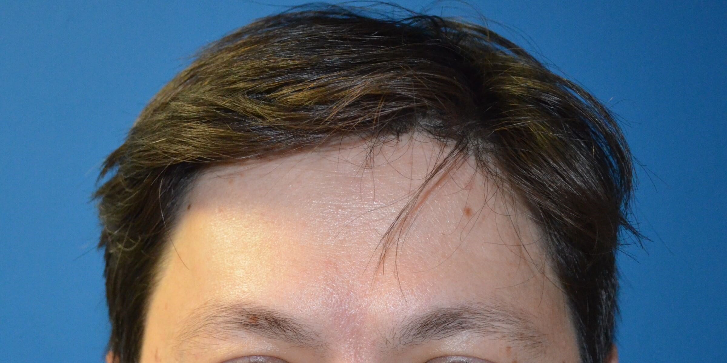 Botox Forehead Crowsfeet After