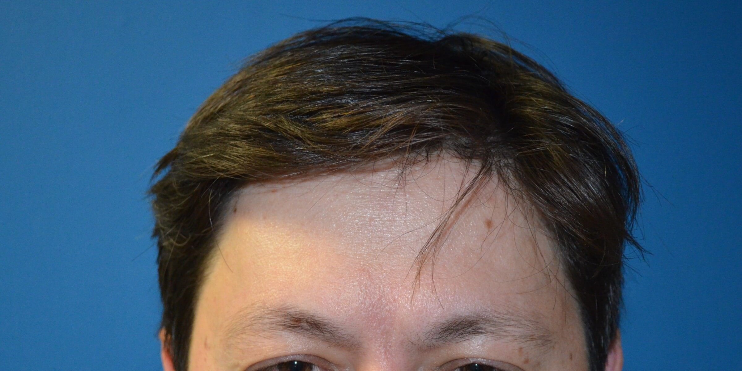 Botox Forehead Crowsfeet After