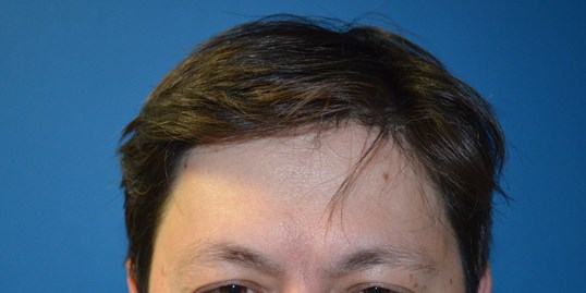Botox Forehead Crowsfeet After