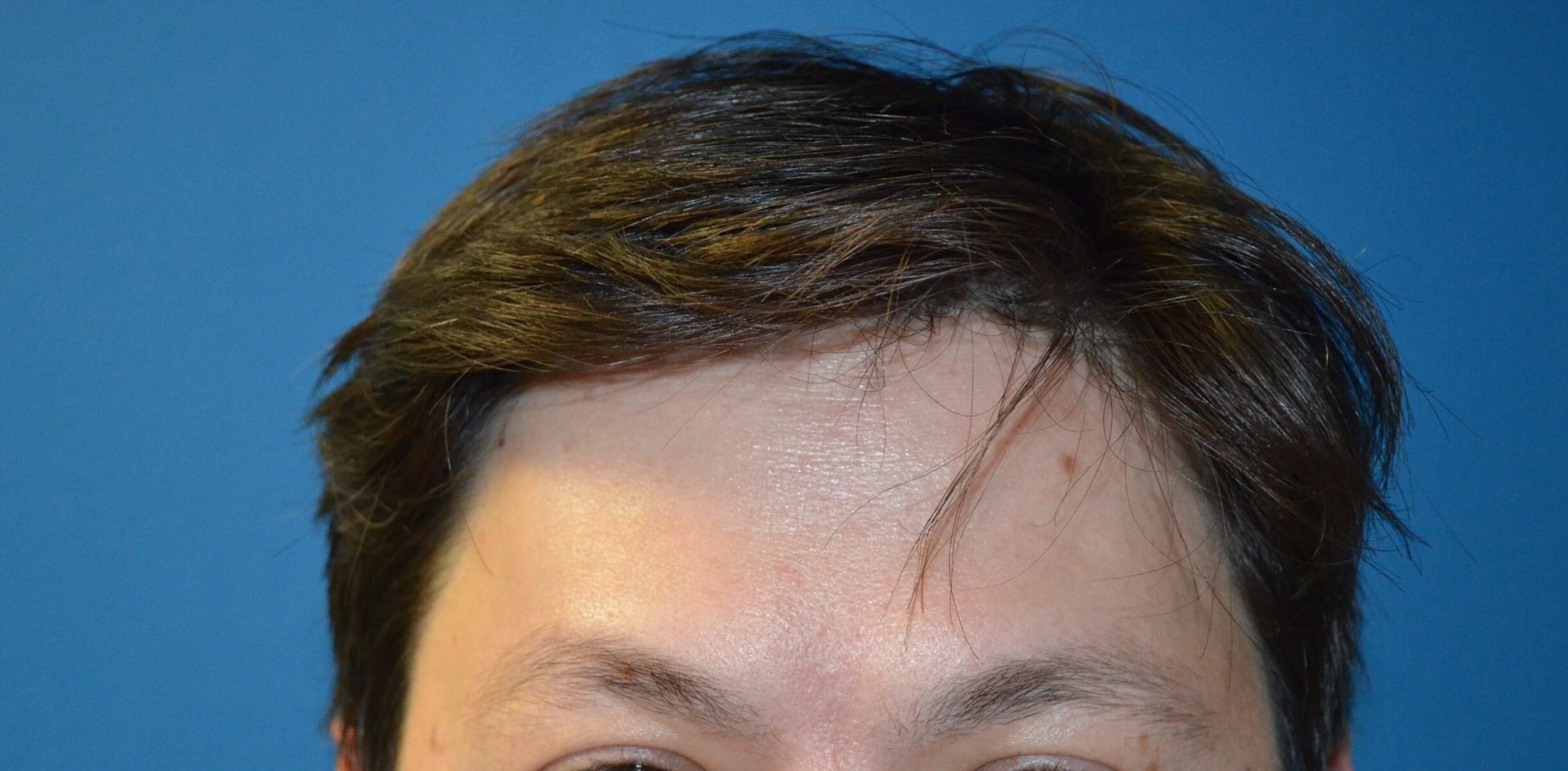 Botox Forehead Crowsfeet After