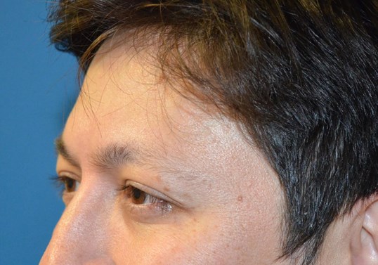 Botox Forehead Crowsfeet After