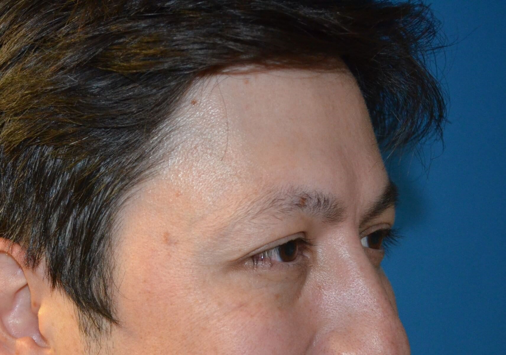 Botox Forehead Crowsfeet After