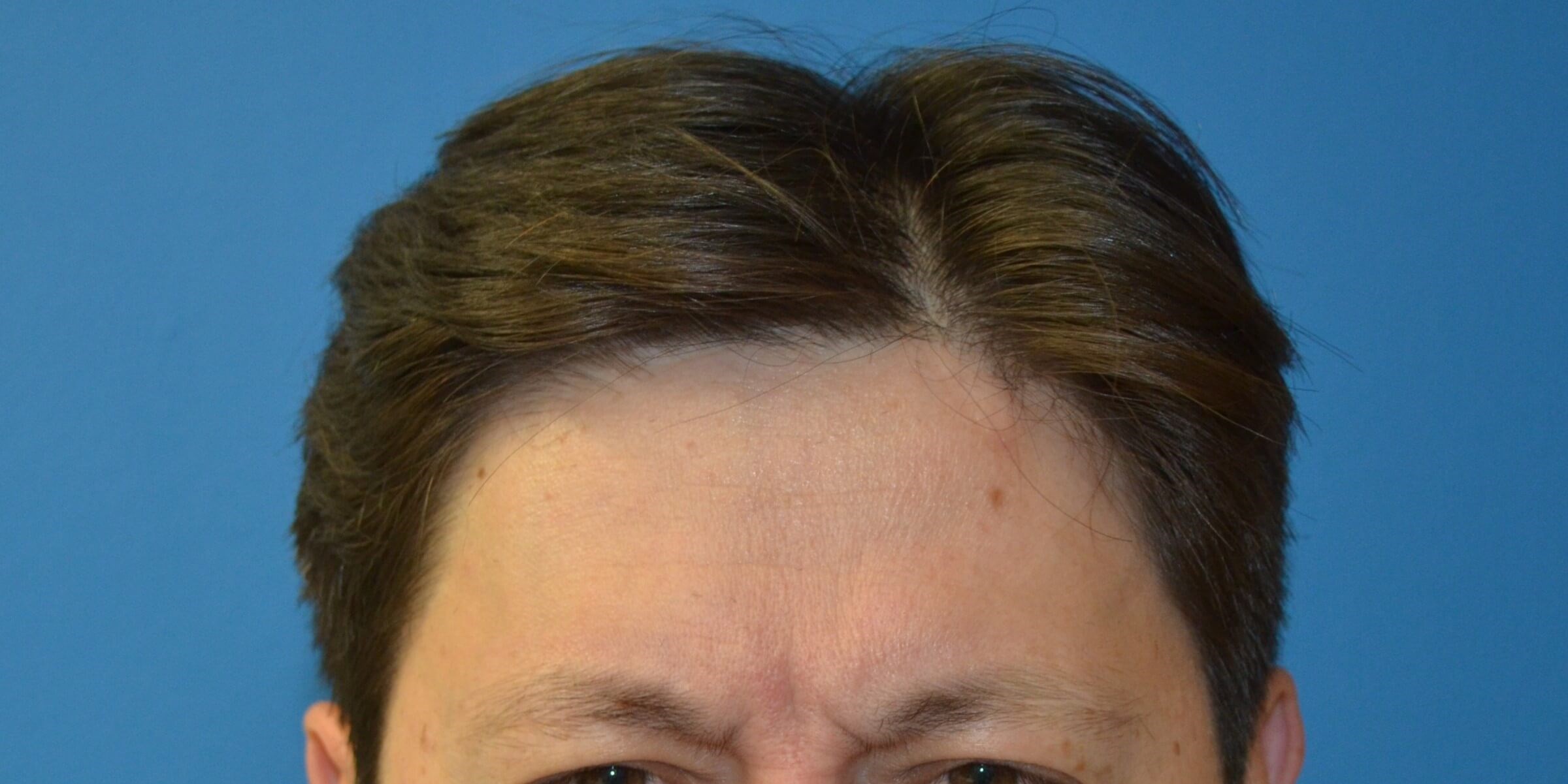 Botox Forehead Crowsfeet Before