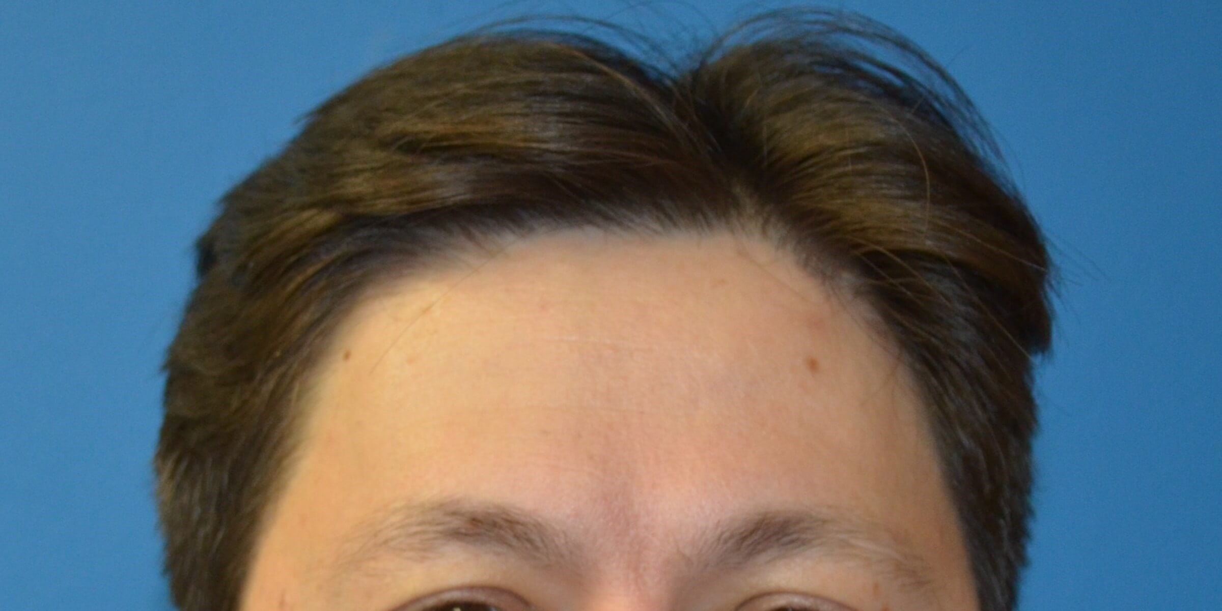 Botox Forehead Crowsfeet Before