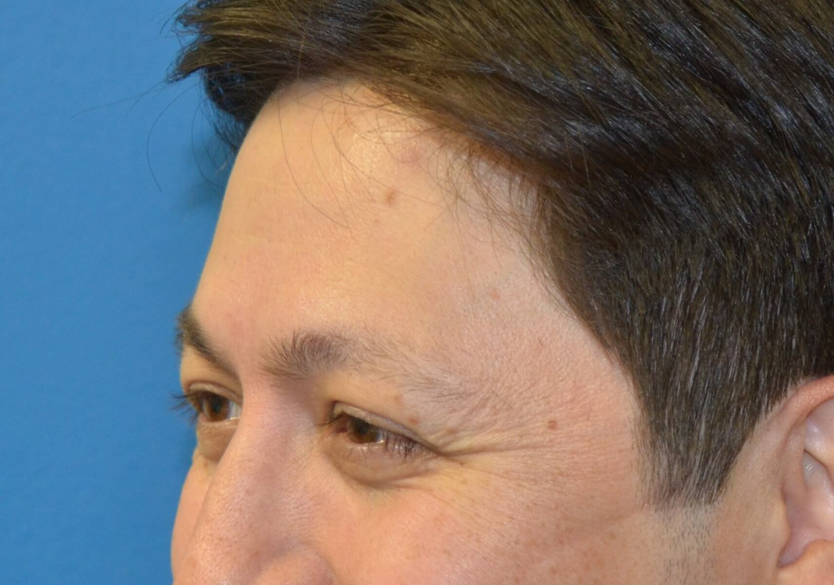 Botox Forehead Crowsfeet Before