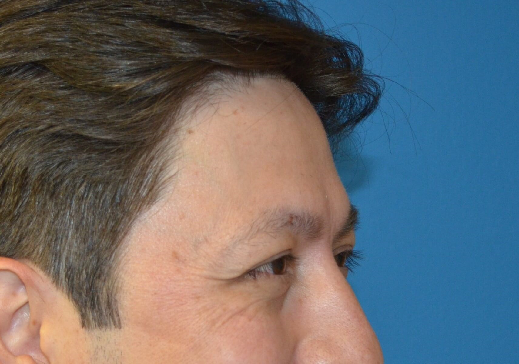 Botox Forehead Crowsfeet Before