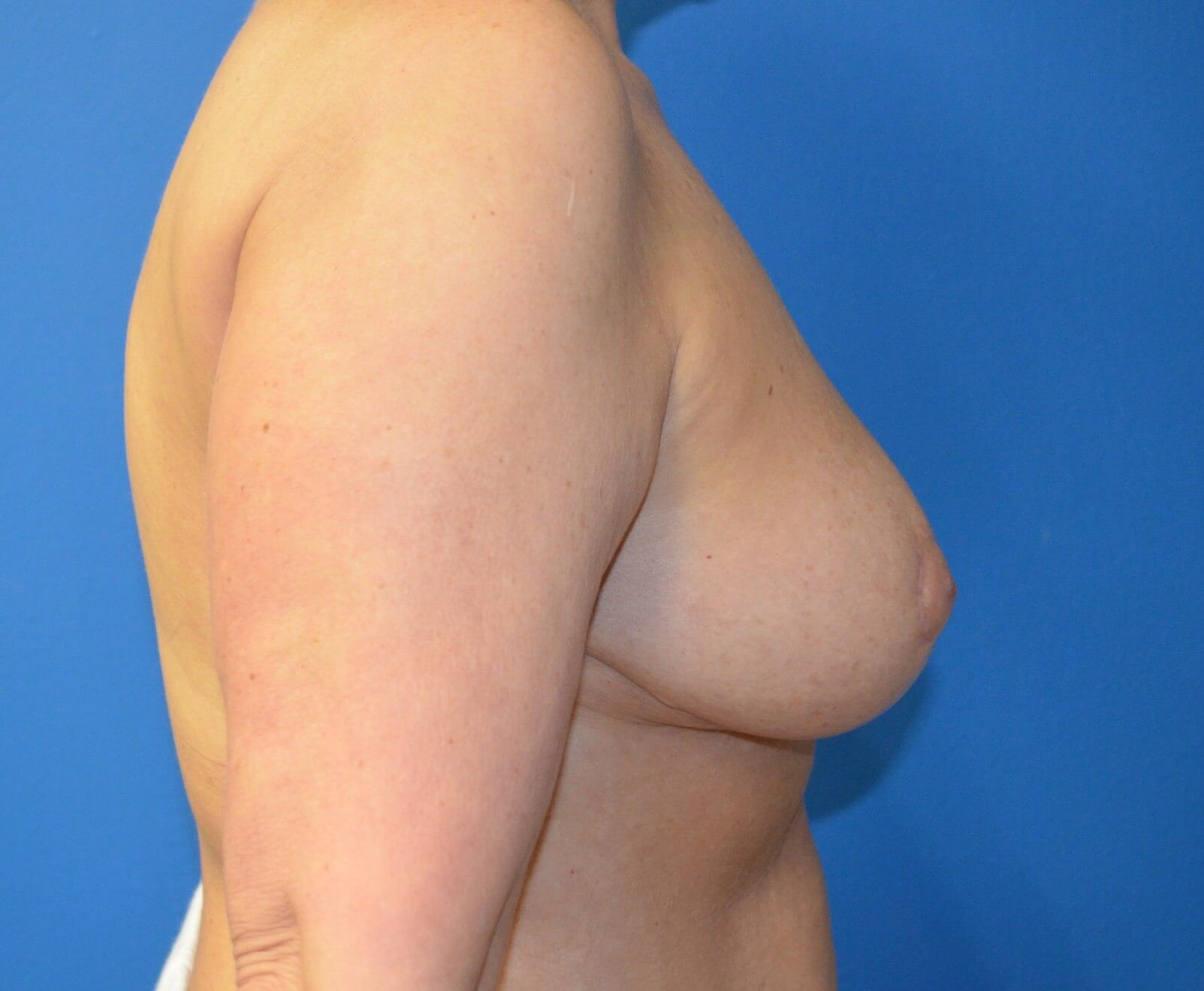 Removal of implants and lift After