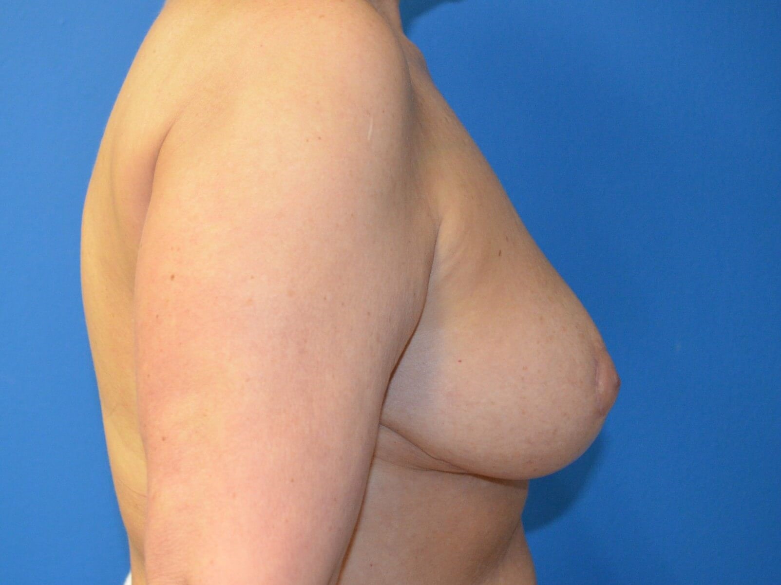Removal of implants and lift After