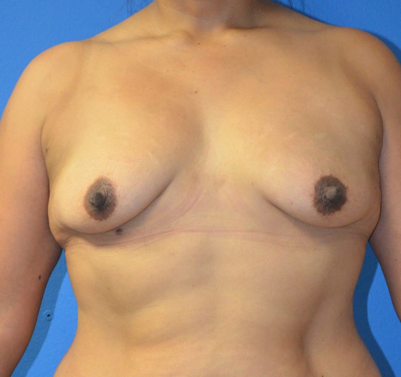 Breast augmentation 385 cc IMF Before