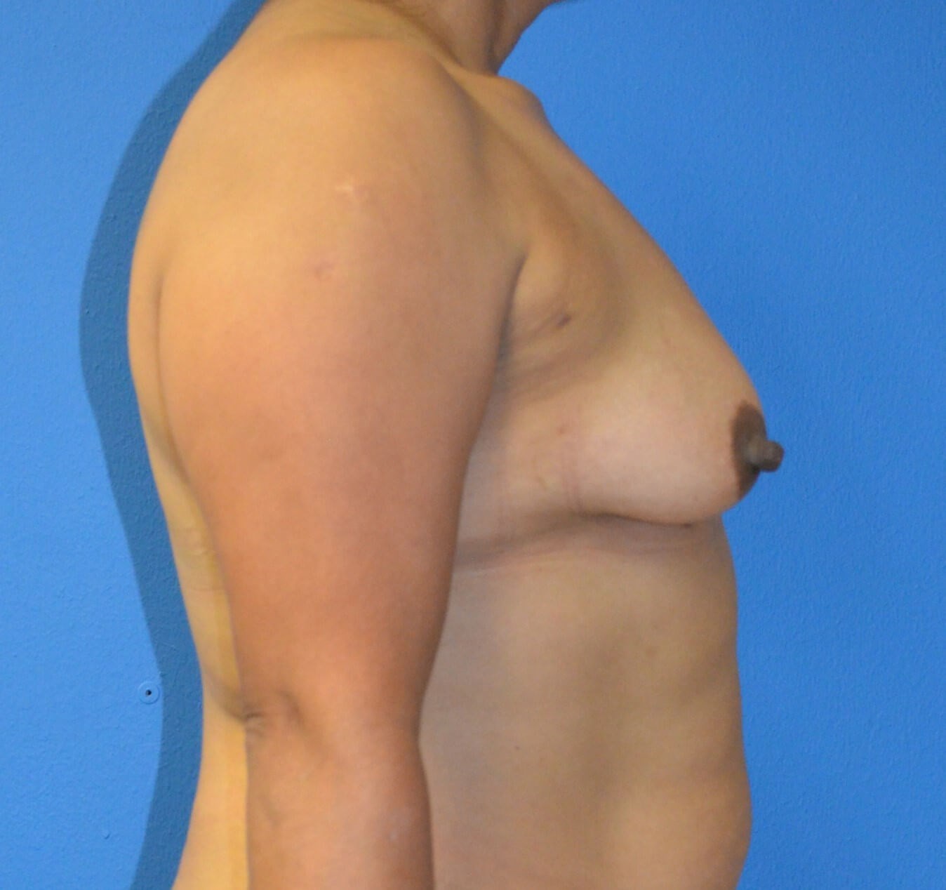 Breast augmentation 385 cc IMF Before