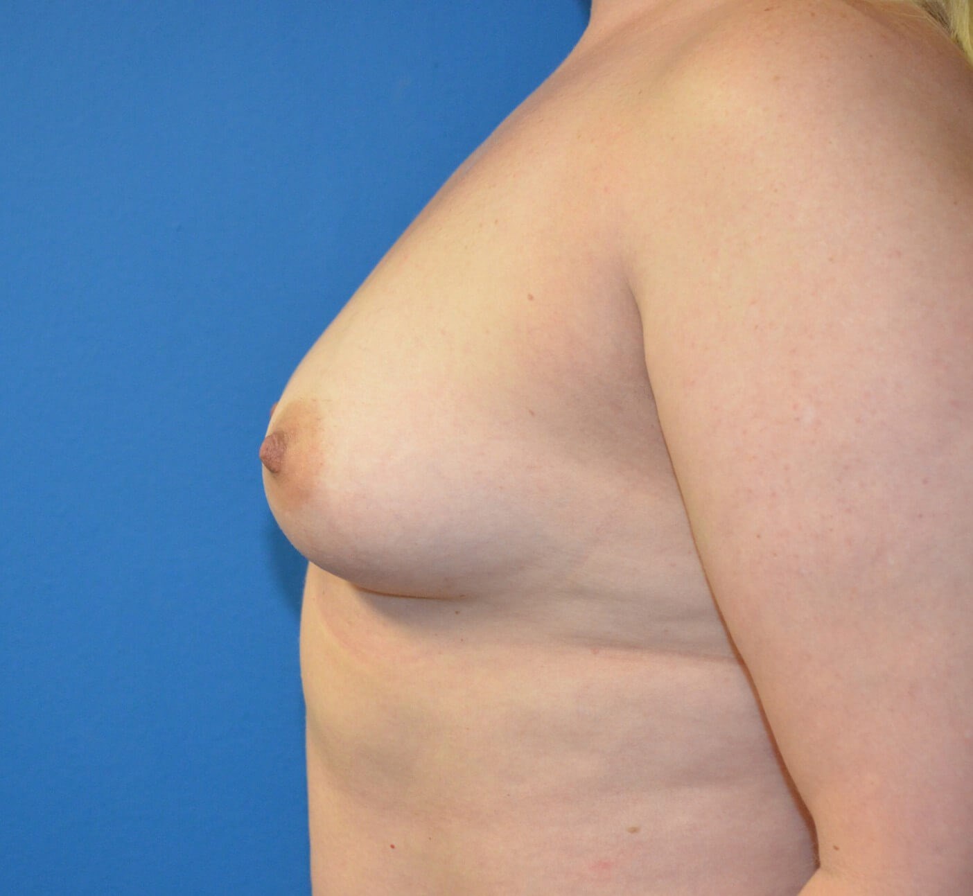 Breast augmentation 510 cc IMF Before
