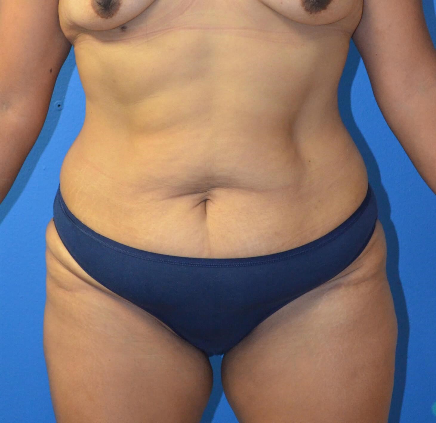 Ultrasound Lipoabdominoplasty Before