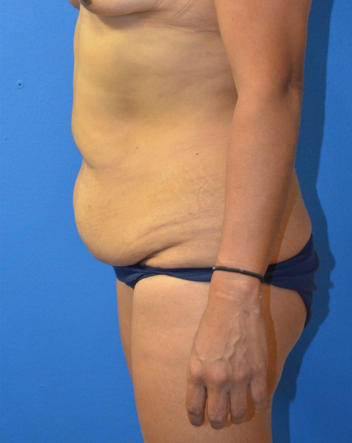 Ultrasound Lipoabdominoplasty Before