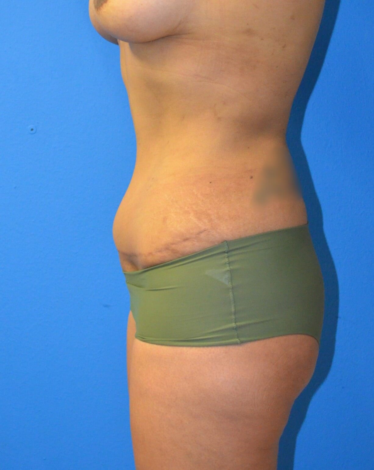 Ultrasound Lipoabdominoplasty After