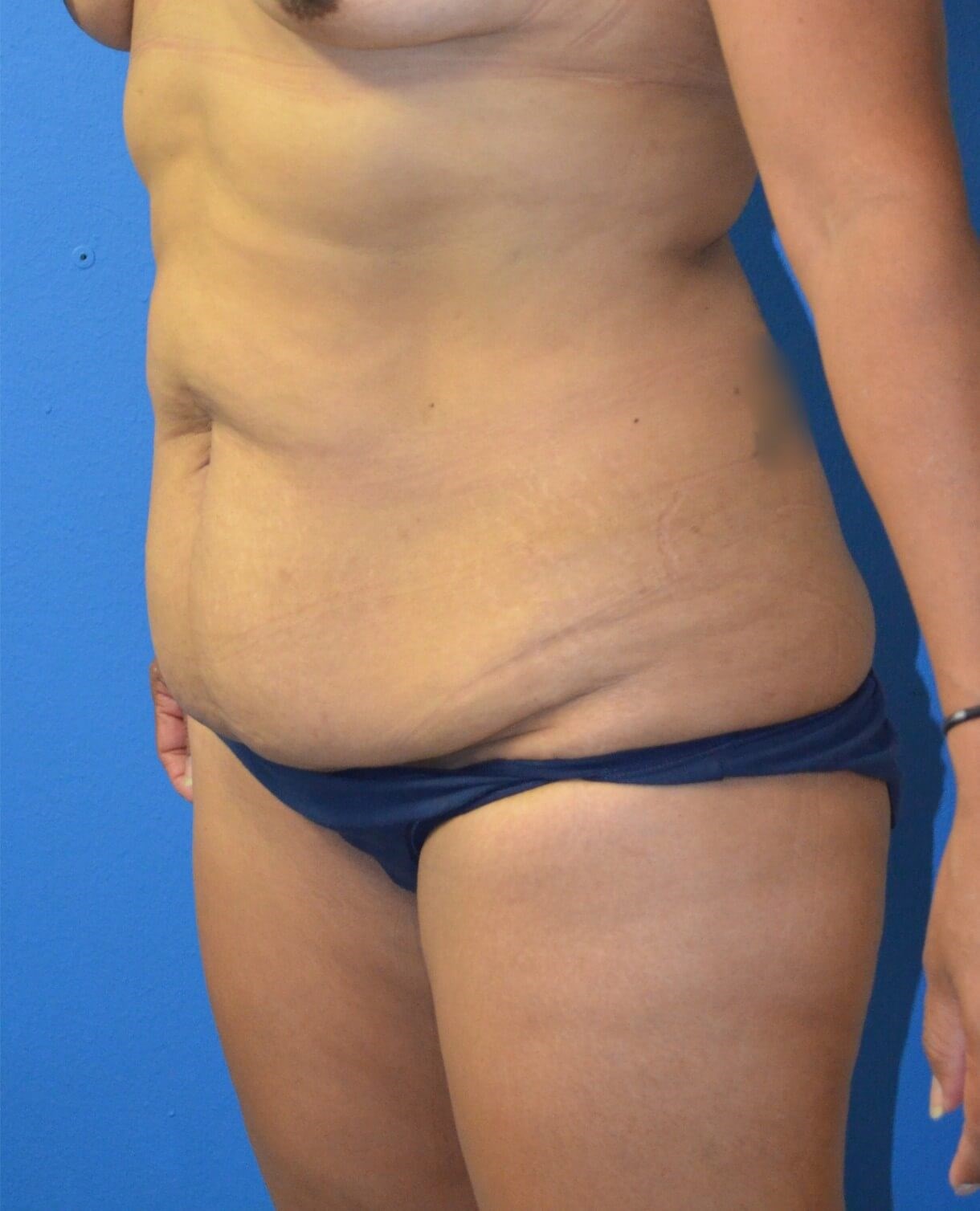 Ultrasound Lipoabdominoplasty Before