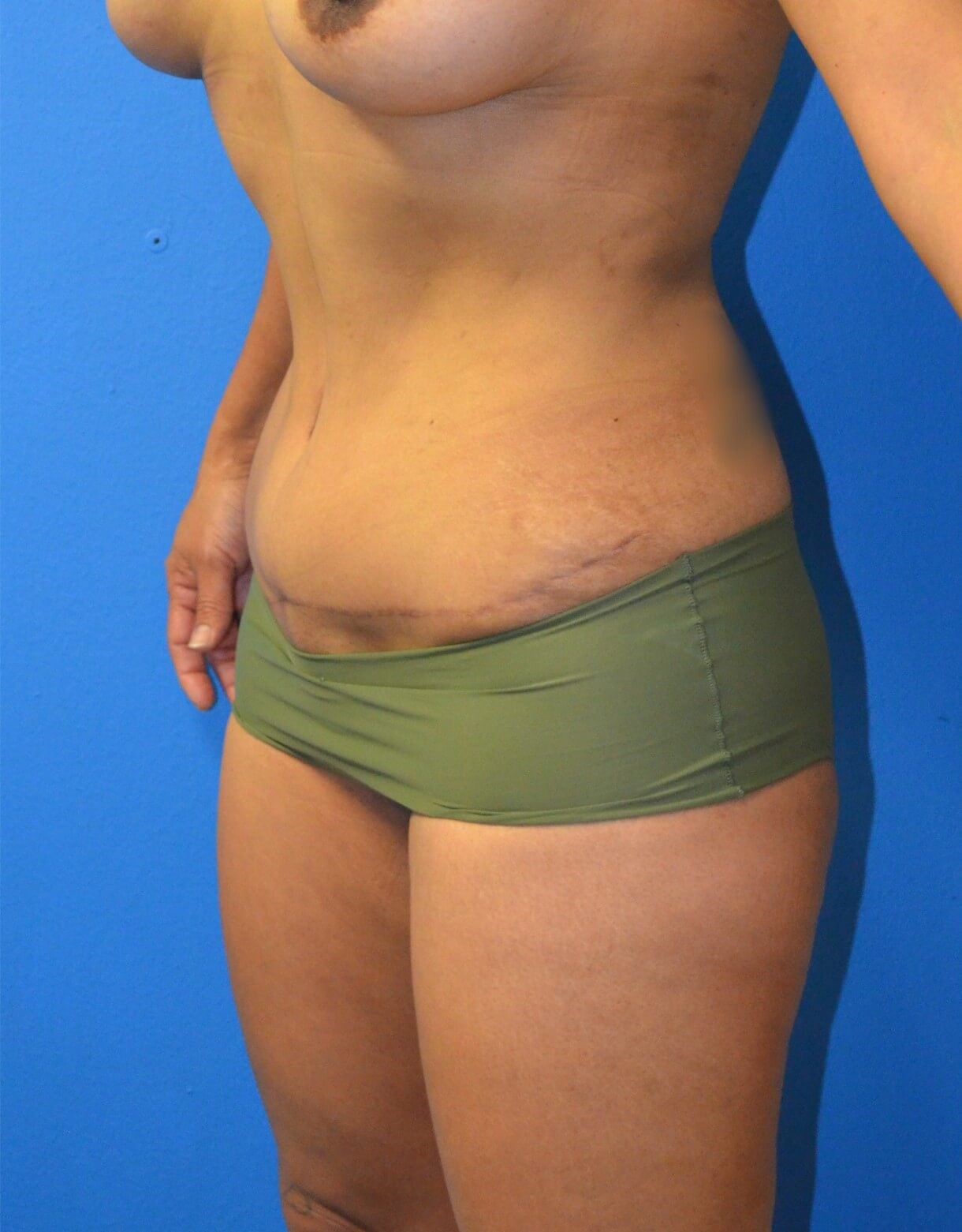 Ultrasound Lipoabdominoplasty After