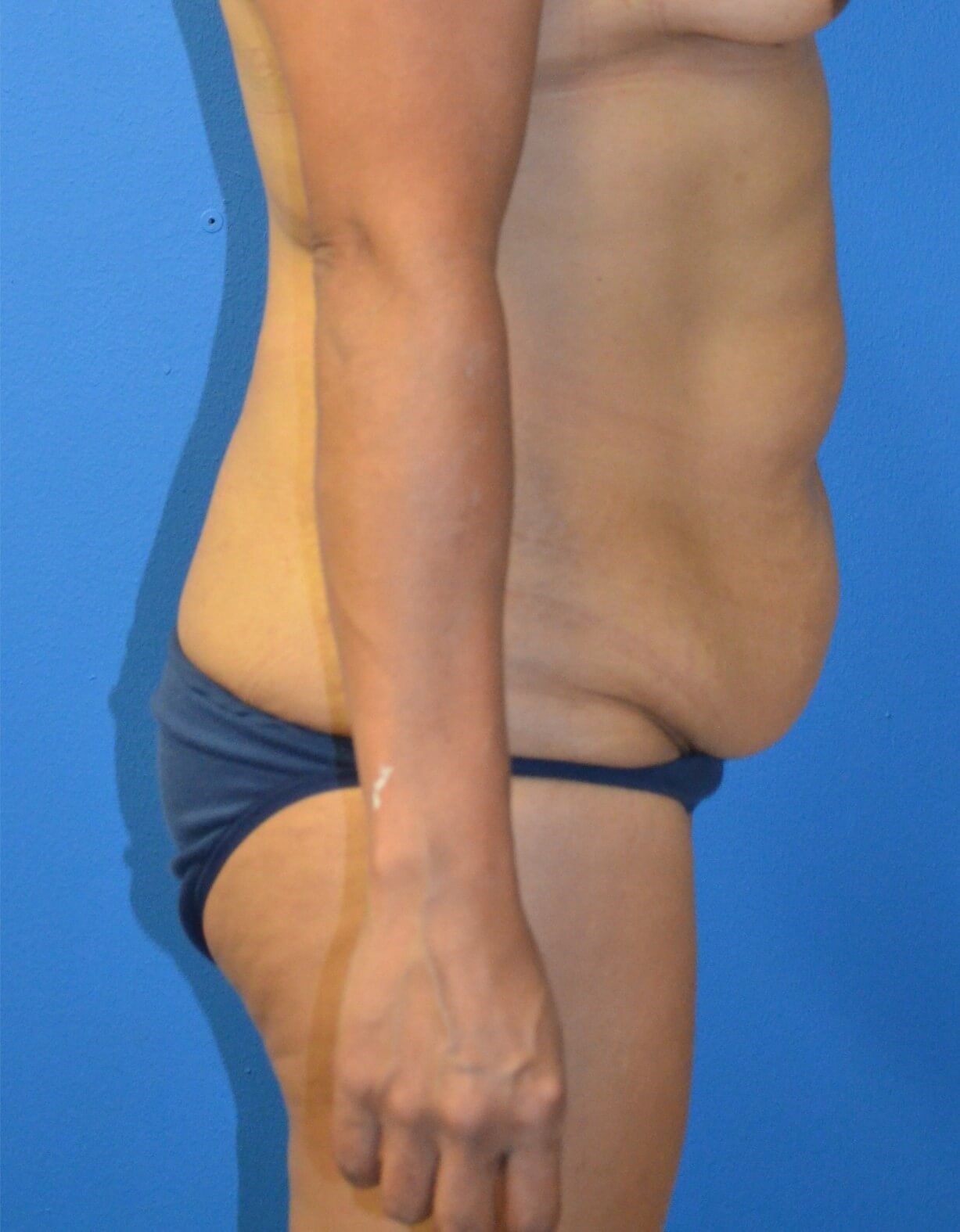Ultrasound Lipoabdominoplasty Before