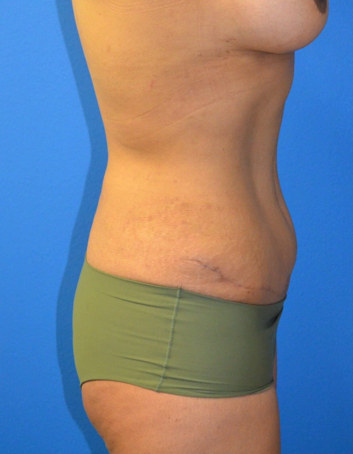 Ultrasound Lipoabdominoplasty After