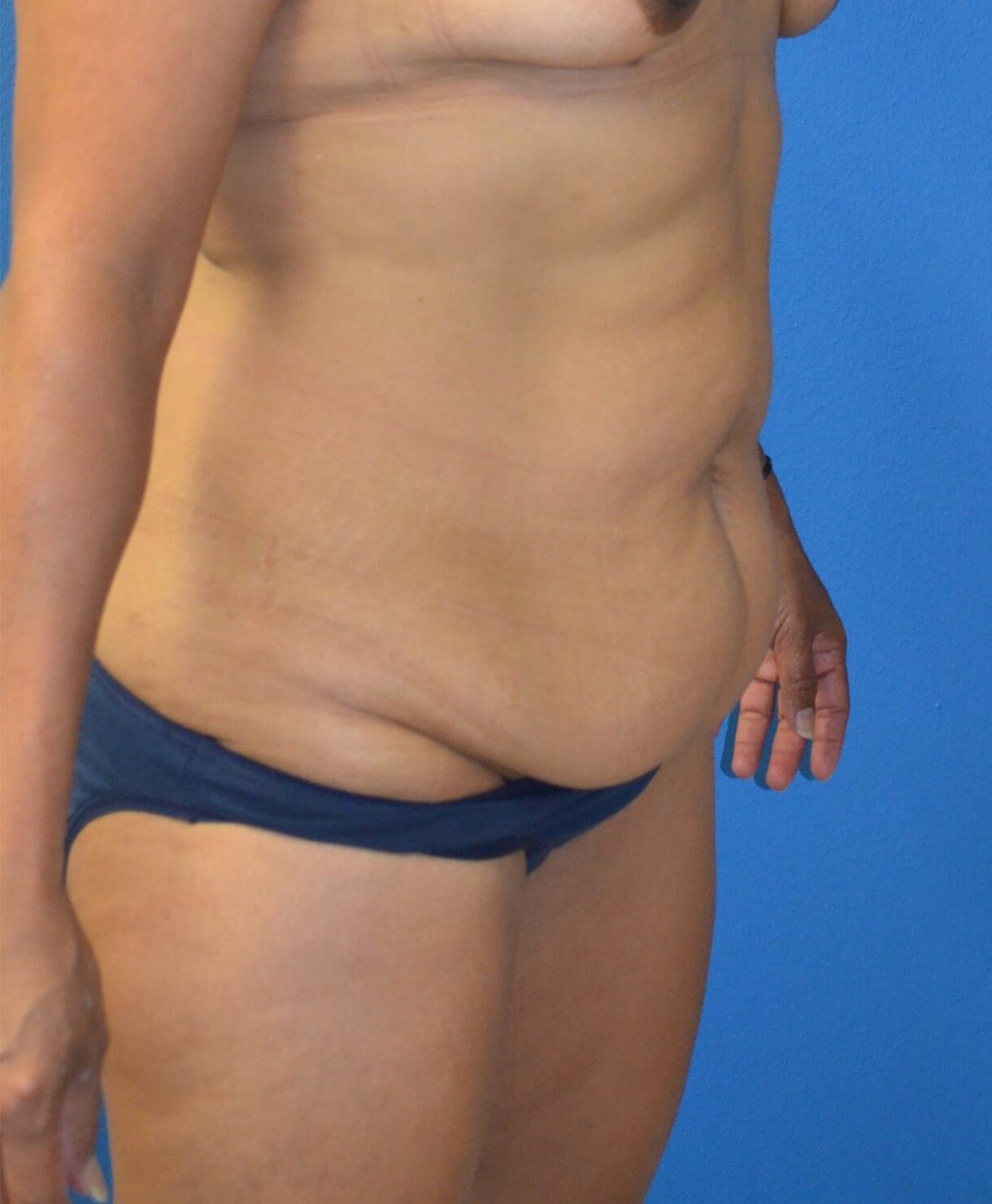 Ultrasound Lipoabdominoplasty Before