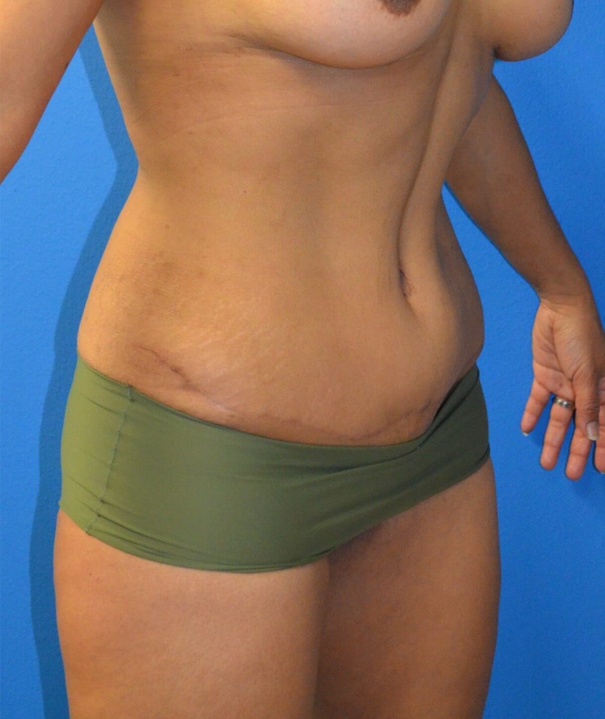 Ultrasound Lipoabdominoplasty After