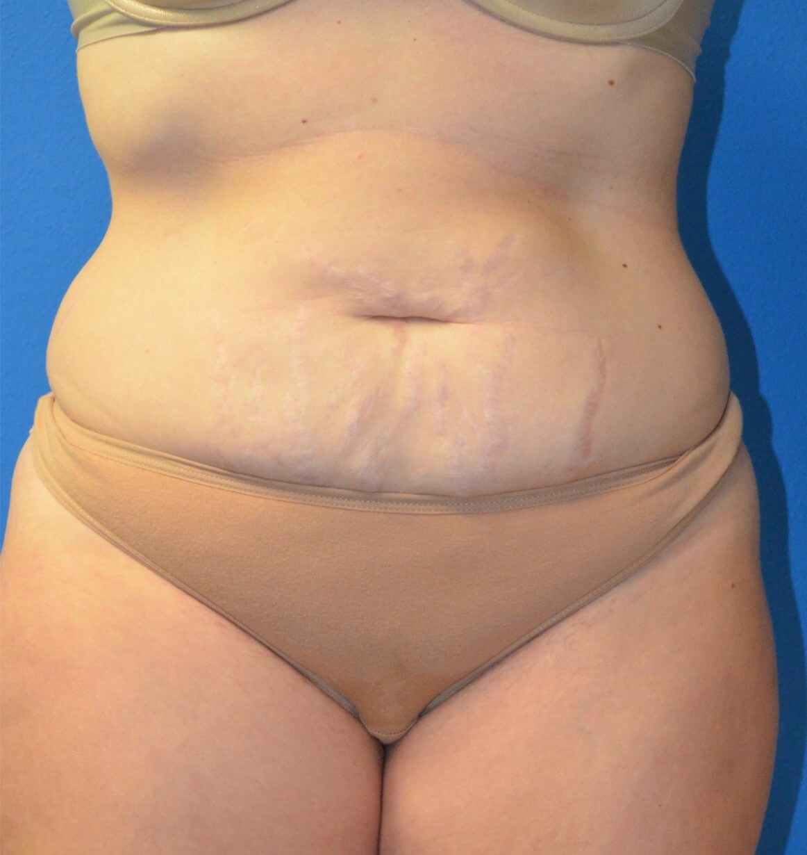 Lipoabdominoplasty Hip fat tx Before