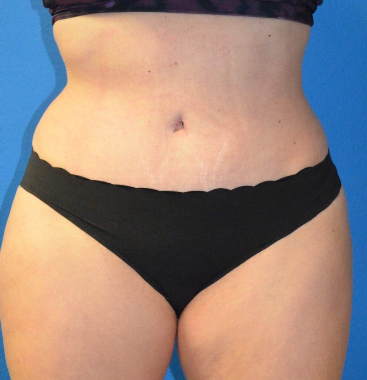 Lipoabdominoplasty Hip fat tx After