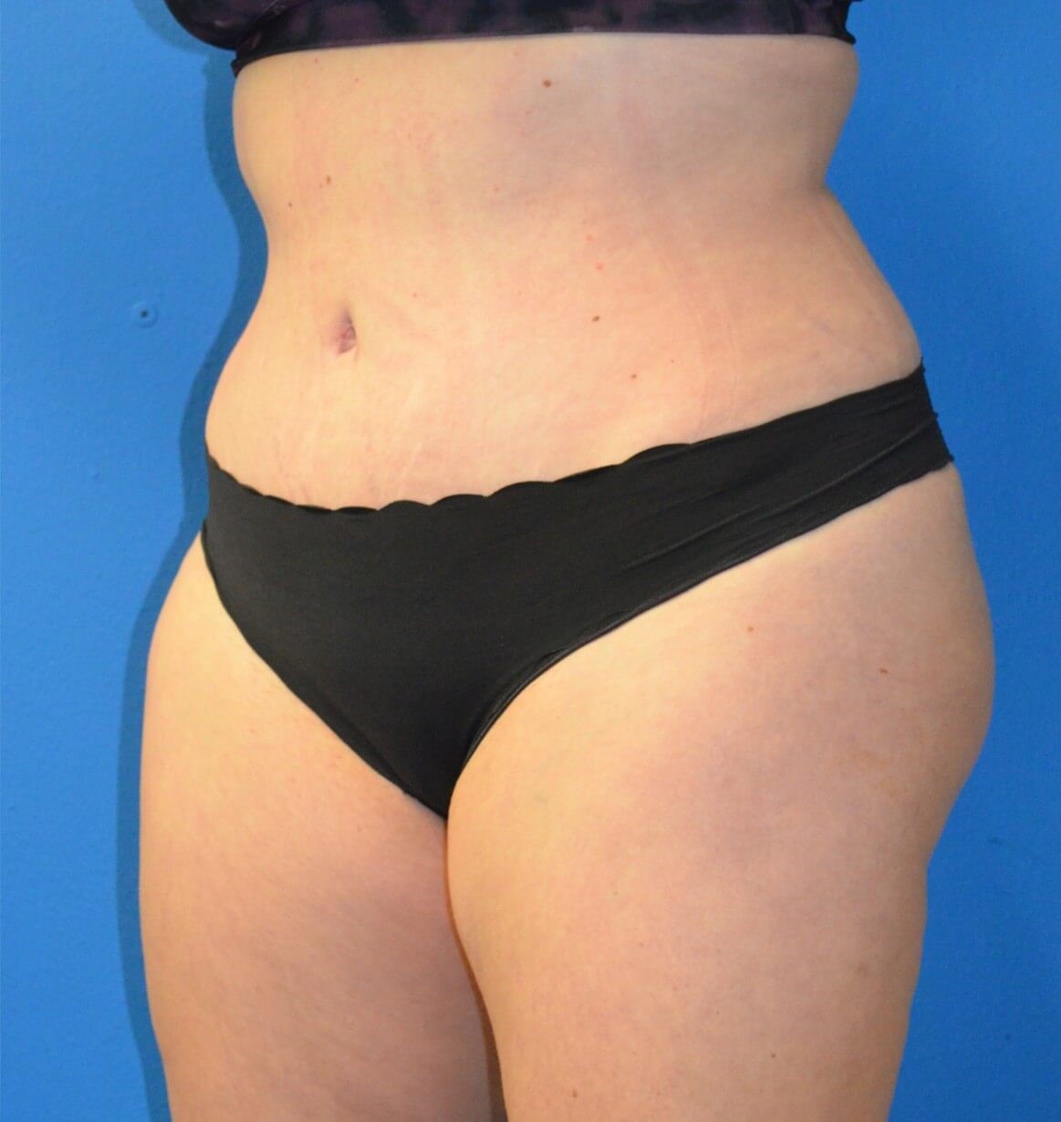 Lipoabdominoplasty Hip fat tx After