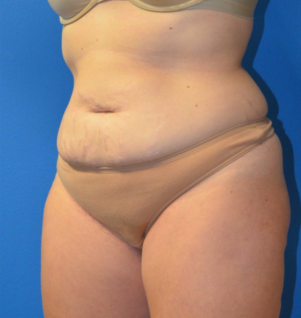 Lipoabdominoplasty Hip fat tx Before