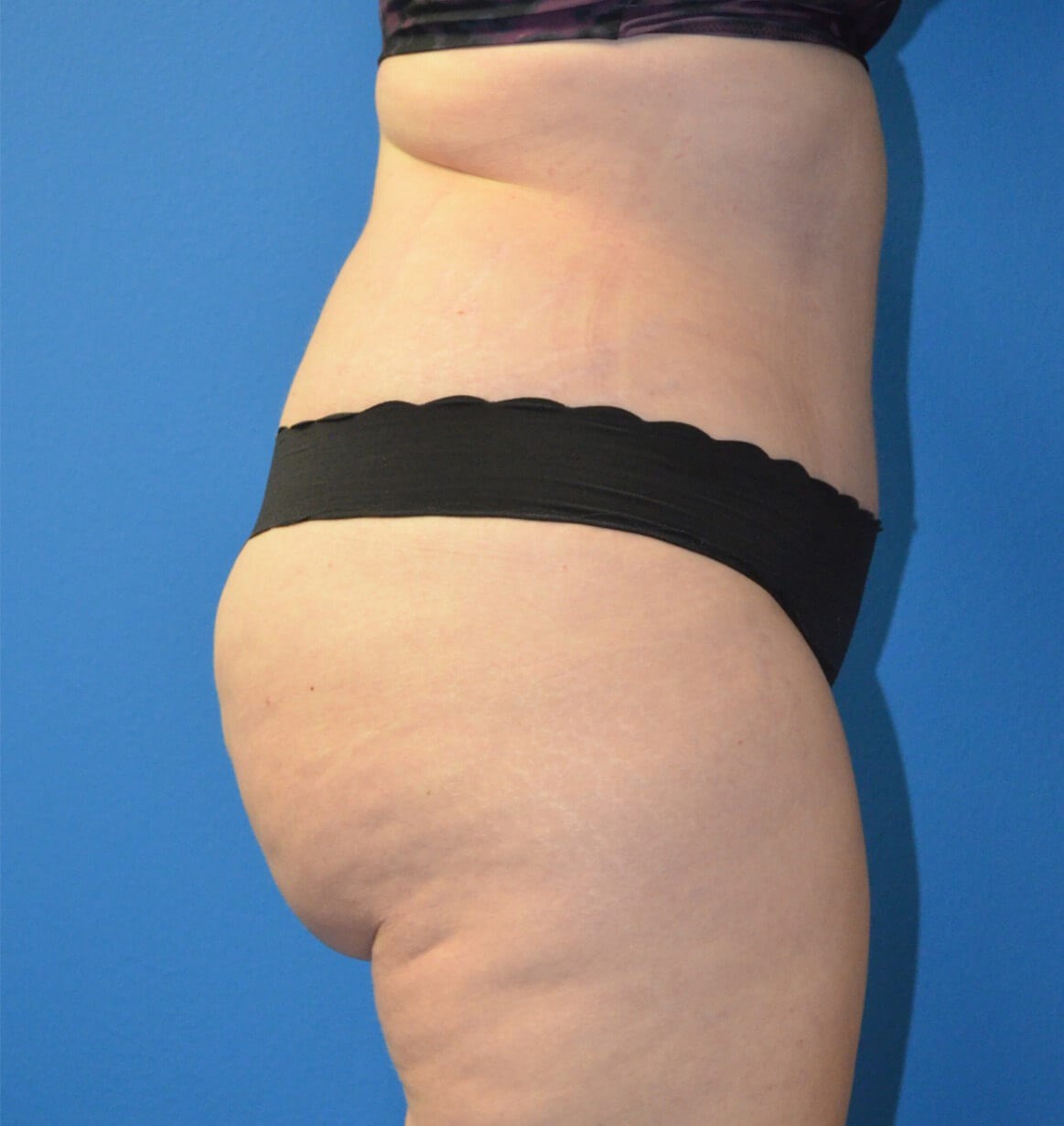 Lipoabdominoplasty Hip fat tx After