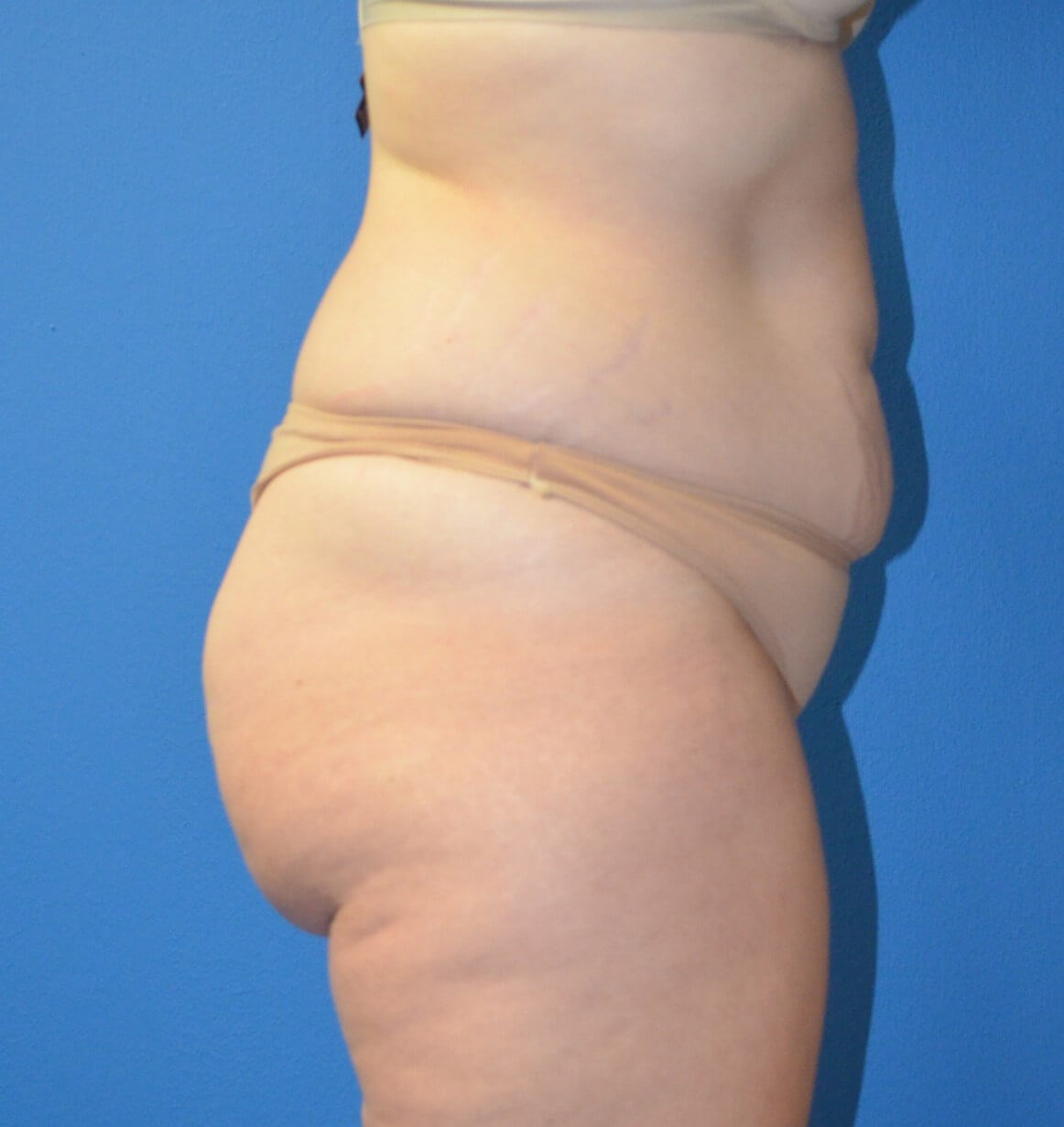Lipoabdominoplasty Hip fat tx Before