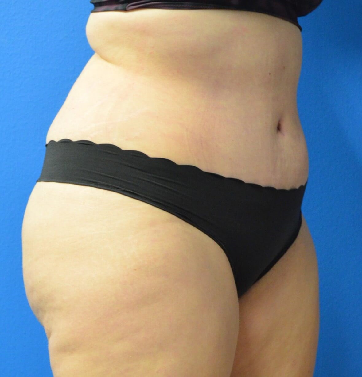 Lipoabdominoplasty Hip fat tx After