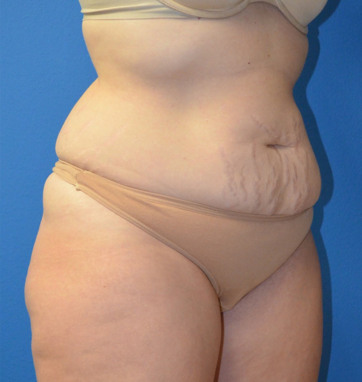 Lipoabdominoplasty Hip fat tx Before