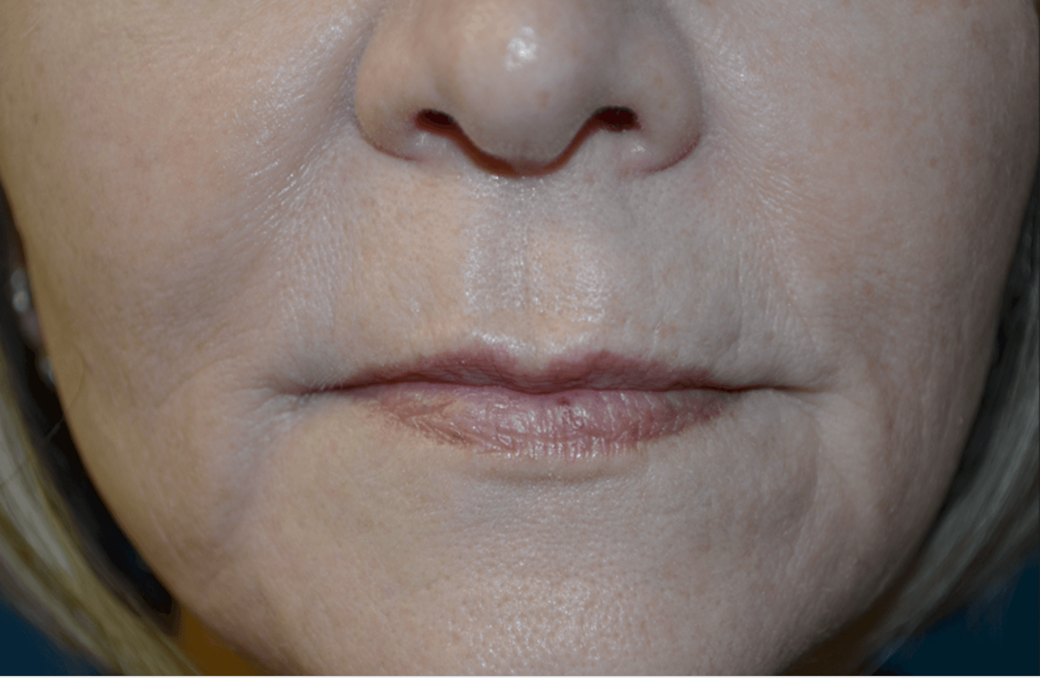 Lip Lift Before