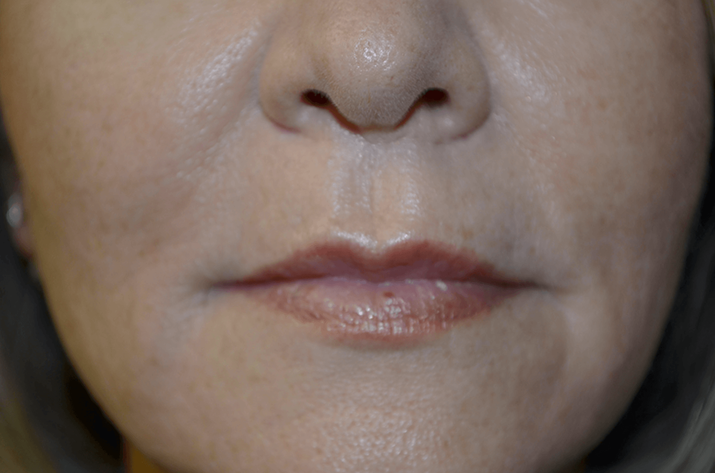 Lip Lift After