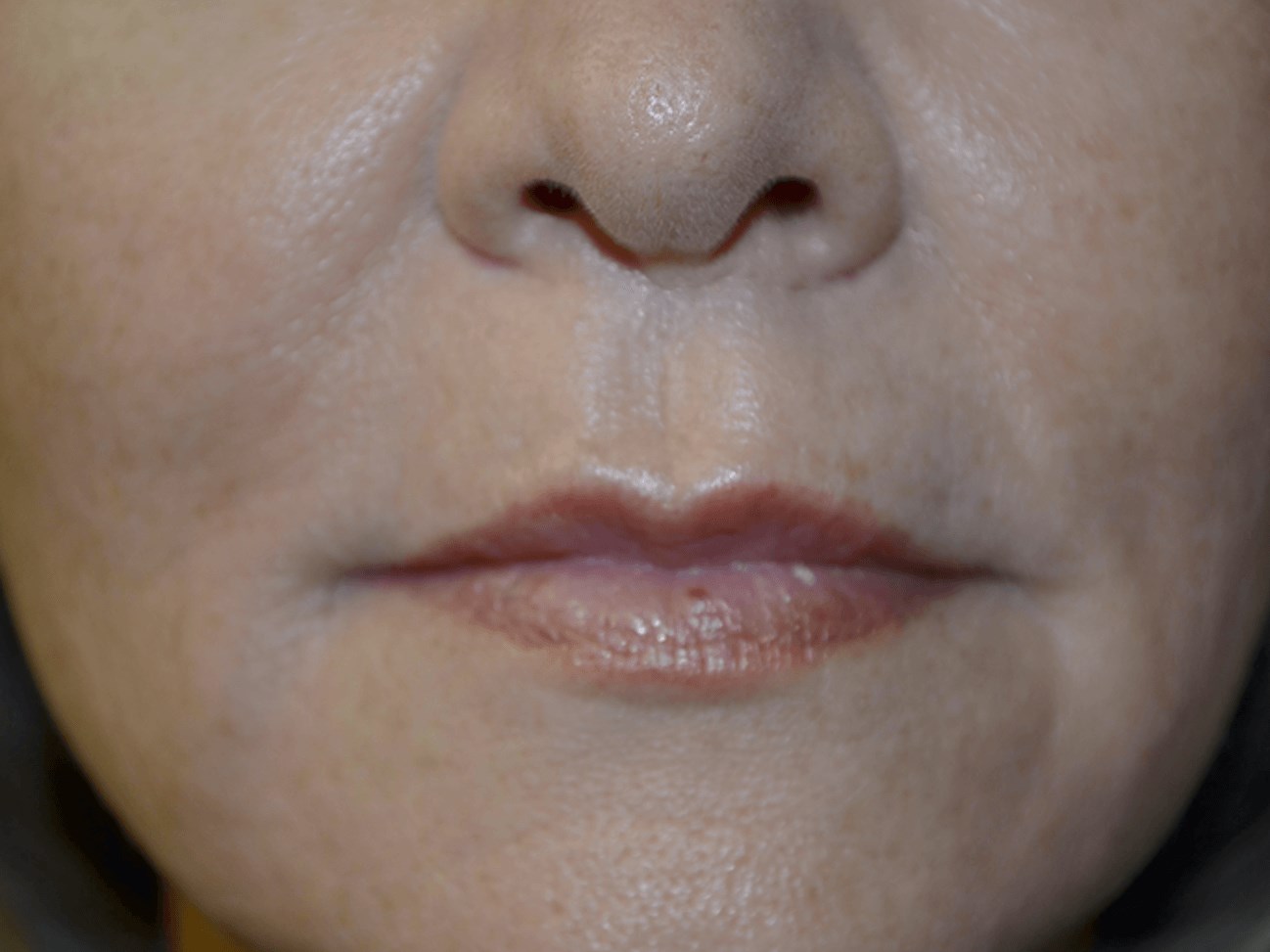Lip Lift After
